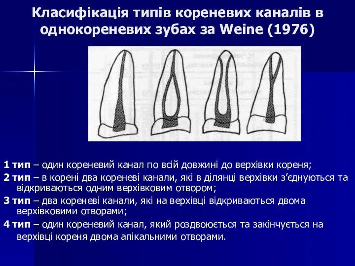 Класифікація типів кореневих каналів в однокореневих зубах за Weine (1976)