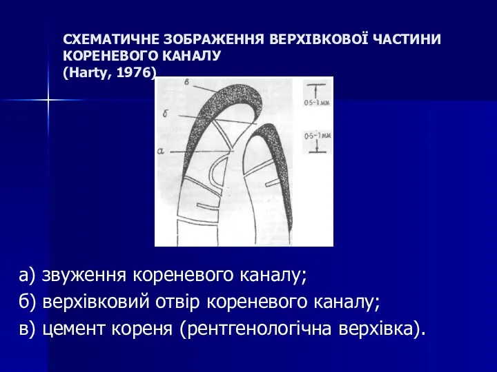 СХЕМАТИЧНЕ ЗОБРАЖЕННЯ ВЕРХІВКОВОЇ ЧАСТИНИ КОРЕНЕВОГО КАНАЛУ (Harty, 1976) а) звуження