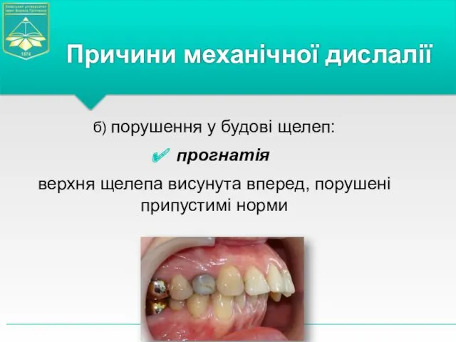 б) порушення у будові щелеп: прогнатія верхня щелепа висунута вперед, порушені припустимі норми Причини механічної дислалії