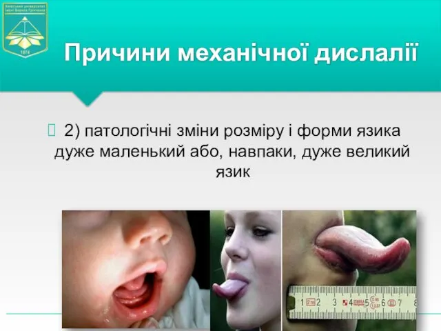 2) патологічні зміни розміру і форми язика дуже маленький або,
