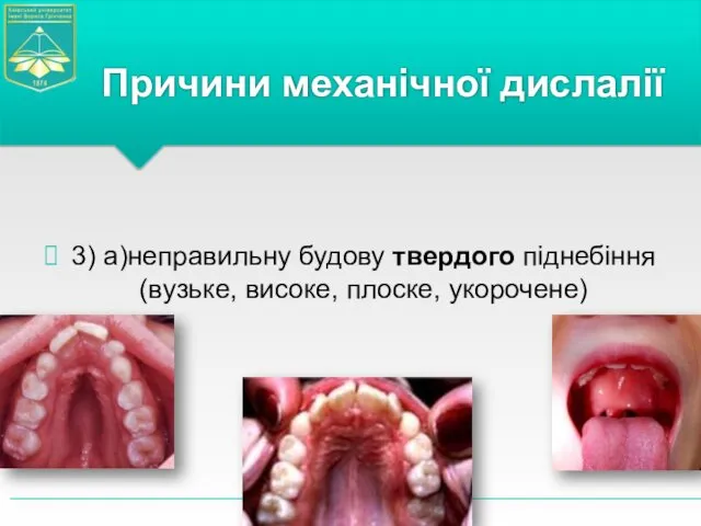 3) а)неправильну будову твердого піднебіння (вузьке, високе, плоске, укорочене) Причини механічної дислалії