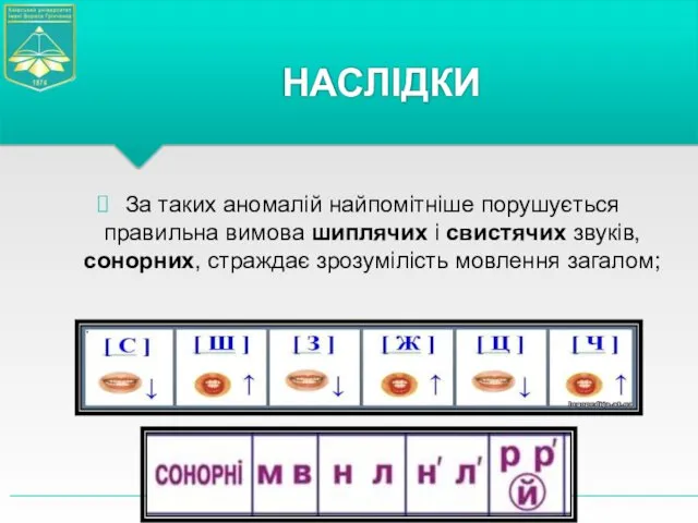 За таких аномалій найпомітніше порушується правильна вимова шиплячих і свистячих