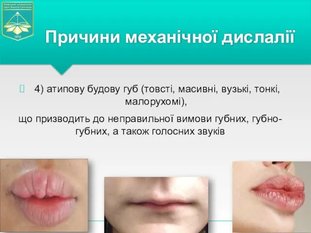 4) атипову будову губ (товсті, масивні, вузькі, тонкі, малорухомі), що