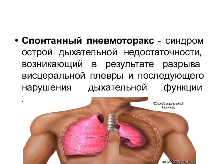 Спонтанный пневмоторакс - синдром острой дыхательной недостаточности, возникающий в результате