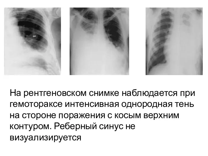 На рентгеновском снимке наблюдается при гемотораксе интенсивная однородная тень на