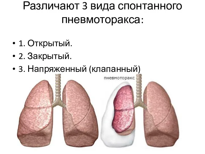 Различают 3 вида спонтанного пневмоторакса: 1. Открытый. 2. Закрытый. 3. Напряженный (клапанный)