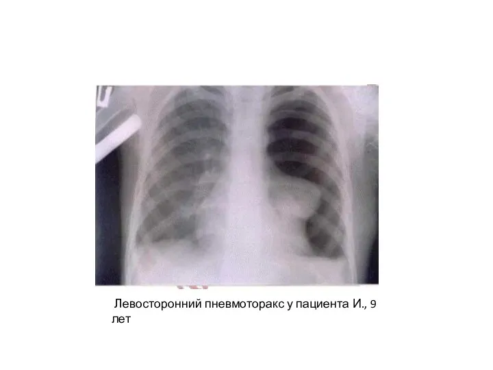 Левосторонний пневмоторакс у пациента И., 9 лет