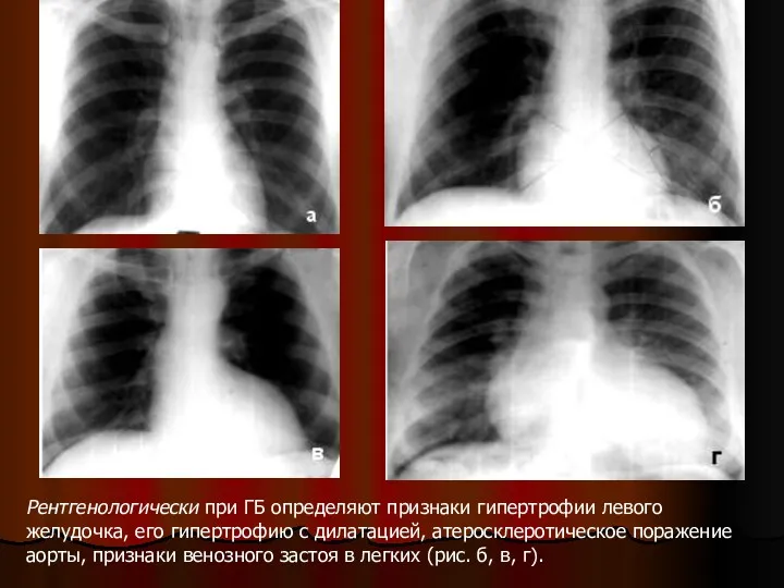 Рентгенологически при ГБ определяют признаки гипертрофии левого желудочка, его гипертрофию с дилатацией, атеросклеротическое