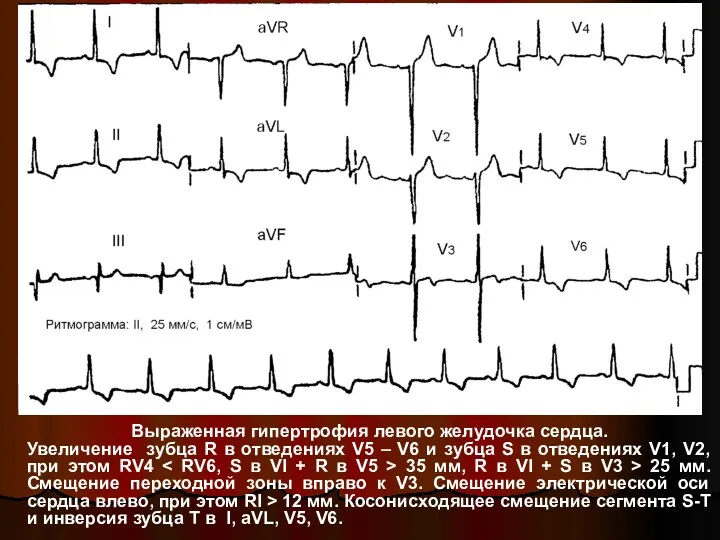Выраженная гипертрофия левого желудочка сердца. Увеличение зубца R в отведениях V5 – V6