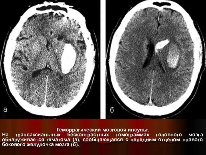 Геморрагический мозговой инсульт. На трансаксиальных бесконтрастных томограммах головного мозга обнаруживается