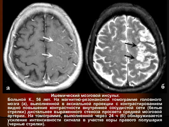 Ишемический мозговой инсульт. Больной К., 56 лет. На магнитно-резонансной томограмме головного мозга (а),