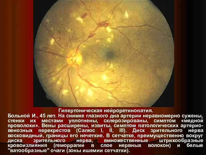 Гипертоническая нейроретинопатия. Больной И., 45 лет. На снимке глазного дна