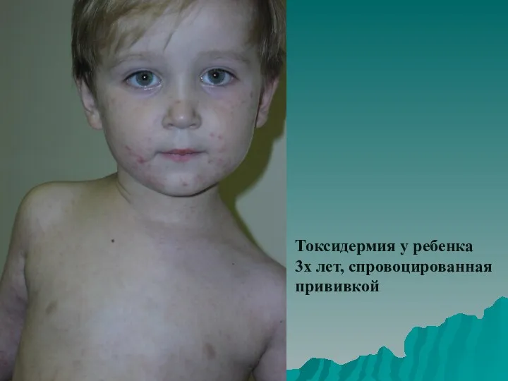 Токсидермия у ребенка 3х лет, спровоцированная прививкой