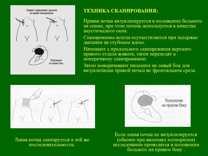 ТЕХНИКА СКАНИРОВАНИЯ: Правая почка визуализируется в положении больного на спине, при этом печень