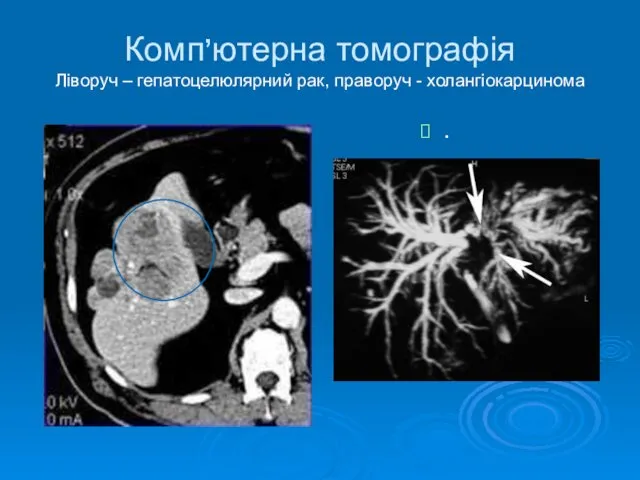 Комп’ютерна томографія Ліворуч – гепатоцелюлярний рак, праворуч - холангіокарцинома .