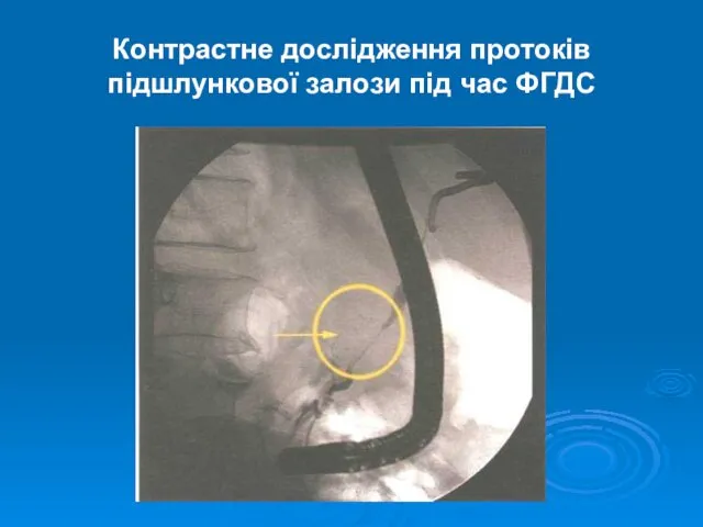 Контрастне дослідження протоків підшлункової залози під час ФГДС