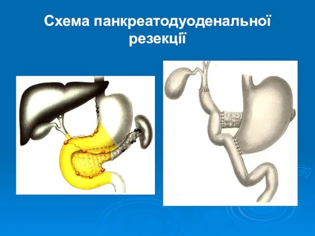 Схема панкреатодуоденальної резекції