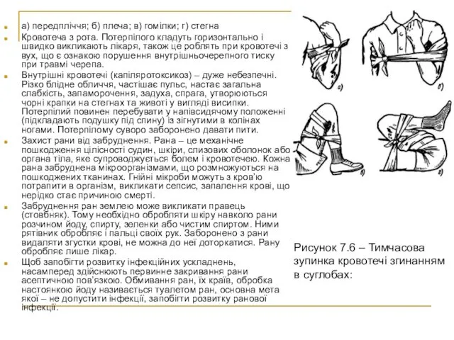 а) передпліччя; б) плеча; в) гомілки; г) стегна Кровотеча з