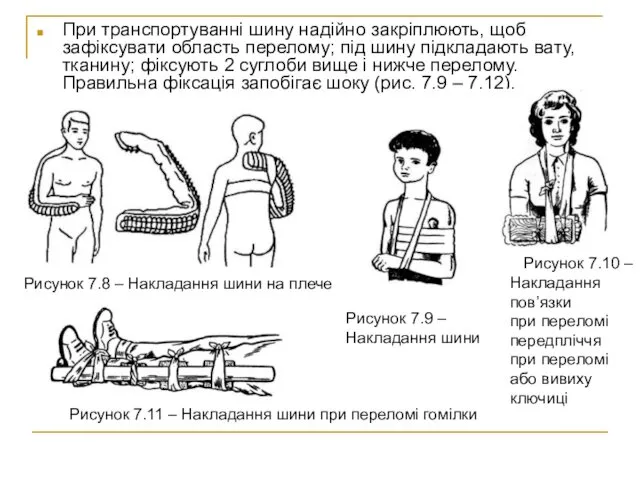 При транспортуванні шину надійно закріплюють, щоб зафіксувати область перелому; під