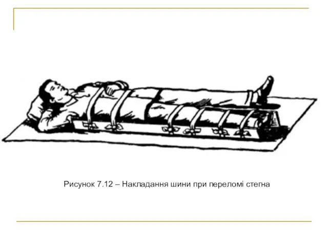 Рисунок 7.12 – Накладання шини при переломі стегна