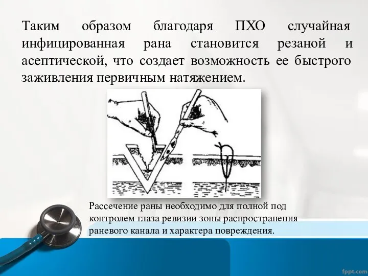 Таким образом благодаря ПХО случайная инфицированная рана становится резаной и