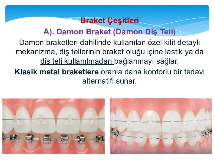 Braket Çeşitleri A). Damon Braket (Damon Diş Teli) Damon braketleri