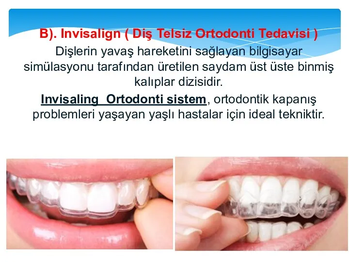 B). Invisalign ( Diş Telsiz Ortodonti Tedavisi ) Dişlerin yavaş hareketini sağlayan bilgisayar