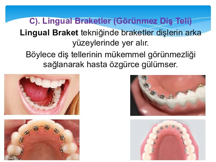 C). Lingual Braketler (Görünmez Diş Teli) Lingual Braket tekniğinde braketler dişlerin arka yüzeylerinde