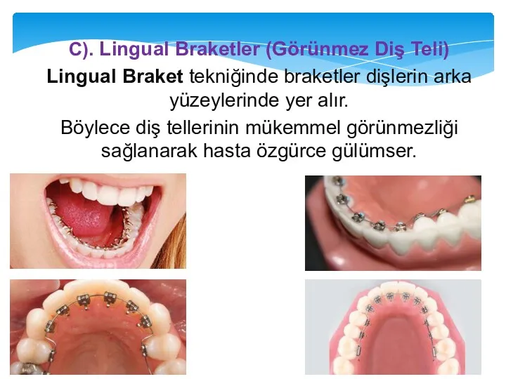 C). Lingual Braketler (Görünmez Diş Teli) Lingual Braket tekniğinde braketler