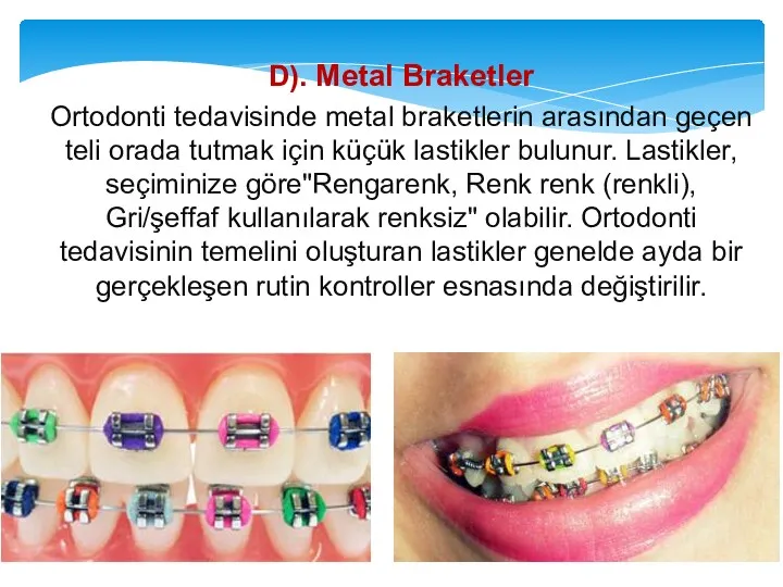 D). Metal Braketler Ortodonti tedavisinde metal braketlerin arasından geçen teli orada tutmak için