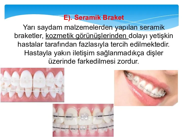 E). Seramik Braket Yarı saydam malzemelerden yapılan seramik braketler, kozmetik görünüşlerinden dolayı yetişkin