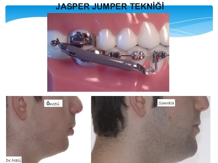 JASPER JUMPER TEKNİĞİ