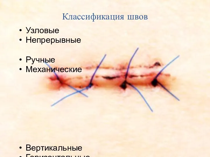 Классификация швов Узловые Непрерывные Ручные Механические Вертикальные Горизонтальные Съемные Погружные