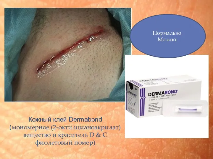 Кожный клей Dermabond (мономерное (2-октилцианоакрилат) вещество и краситель D & C фиолетовый номер) Нормально. Можно.