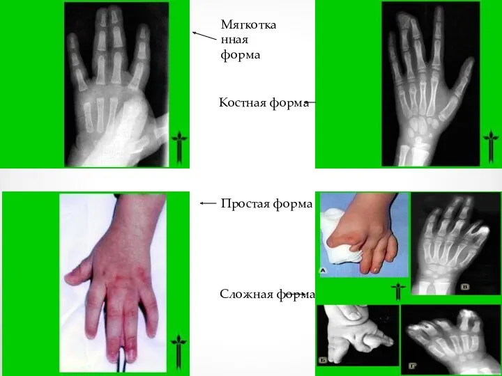 Мягкотканная форма Костная форма Простая форма Сложная форма