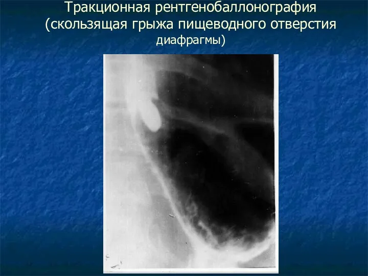 Тракционная рентгенобаллонография (скользящая грыжа пищеводного отверстия диафрагмы)