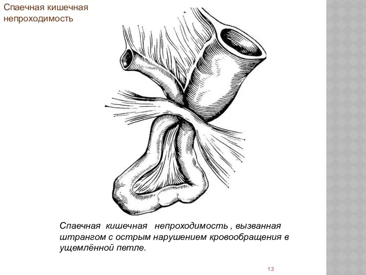 Спаечная кишечная непроходимость , вызванная штрангом с острым нарушением кровообращения в ущемлённой петле. Спаечная кишечная непроходимость