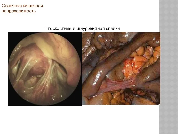 Плоскостные и шнуровидная спайки Спаечная кишечная непроходимость