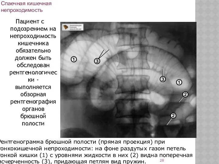 Спаечная кишечная непроходимость Пациент с подозрением на непроходимость кишечника обязательно