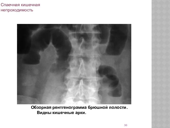 Спаечная кишечная непроходимость Обзорная рентгенограмма брюшной полости. Видны кишечные арки.