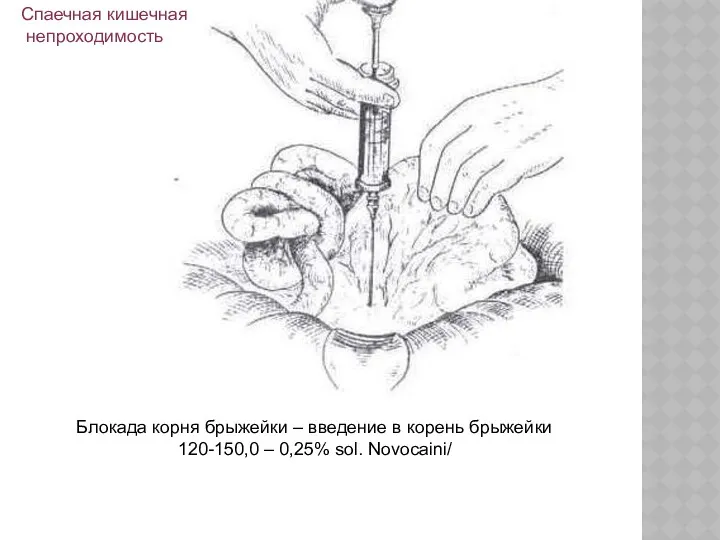 Блокада корня брыжейки – введение в корень брыжейки 120-150,0 – 0,25% sol. Novocaini/ Спаечная кишечная непроходимость