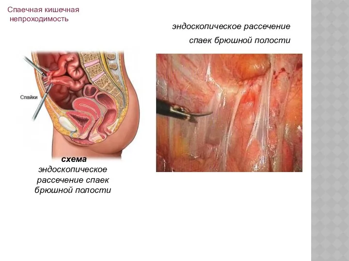 эндоскопическое рассечение спаек брюшной полости схема эндоскопическое рассечение спаек брюшной полости Спаечная кишечная непроходимость