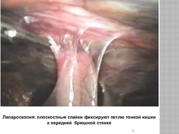 Лапароскопия: плоскостные спайки фиксируют петлю тонкой кишки к передней брюшной стенке
