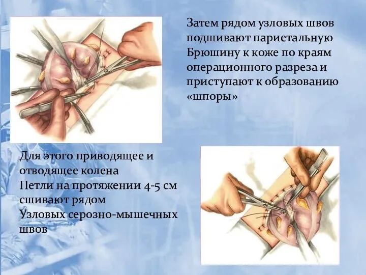 Затем рядом узловых швов подшивают париетальную Брюшину к коже по краям операционного разреза