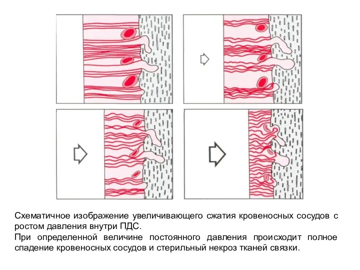 Схематичное изображение увеличивающего сжатия кровеносных сосудов с ростом давления внутри