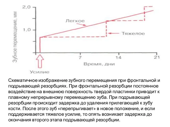 Схематичное изображение зубного перемещения при фронталь­ной и подрывающей резорбциях. При