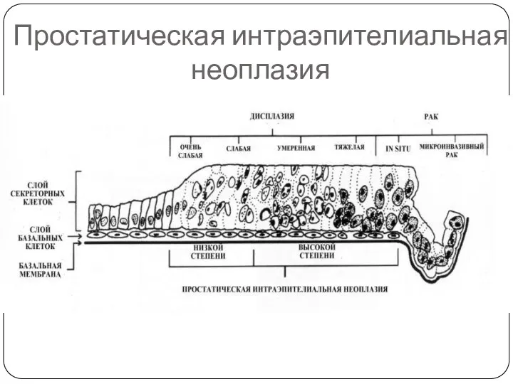 Простатическая интраэпителиальная неоплазия