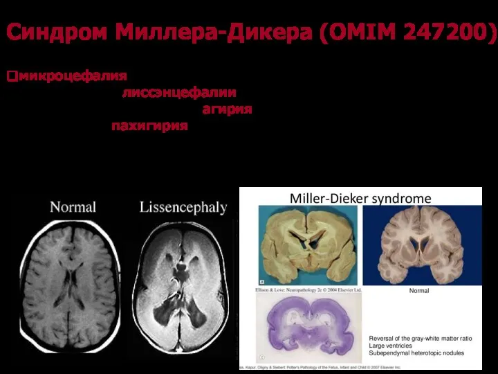 Синдром Миллера-Дикера (OMIM 247200) Клинические признаками синдрома Миллера-Дикера микроцефалия и тяжелые нарушения развития