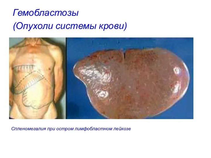 Гемобластозы (Опухоли системы крови) Спленомегалия при остром лимфобластном лейкозе