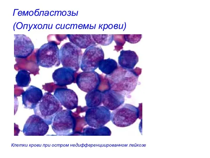 Гемобластозы (Опухоли системы крови) Клетки крови при остром недифференциированном лейкозе